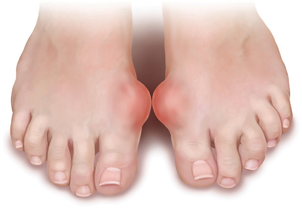 Hạt tophi ở chân người bệnh gout