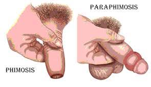 Paraphimosis