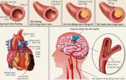 cấu trúc vi thể và biến chứng của xơ mỡ động mạch