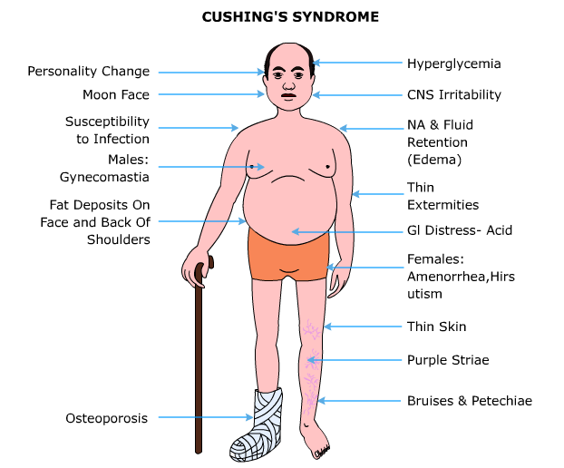 hội chứng Cushing