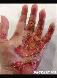 nhiễm trùng bàn tay