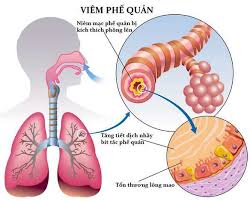 viêm phế quản phổi