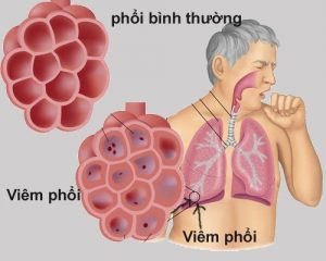 viêm phổi thùy